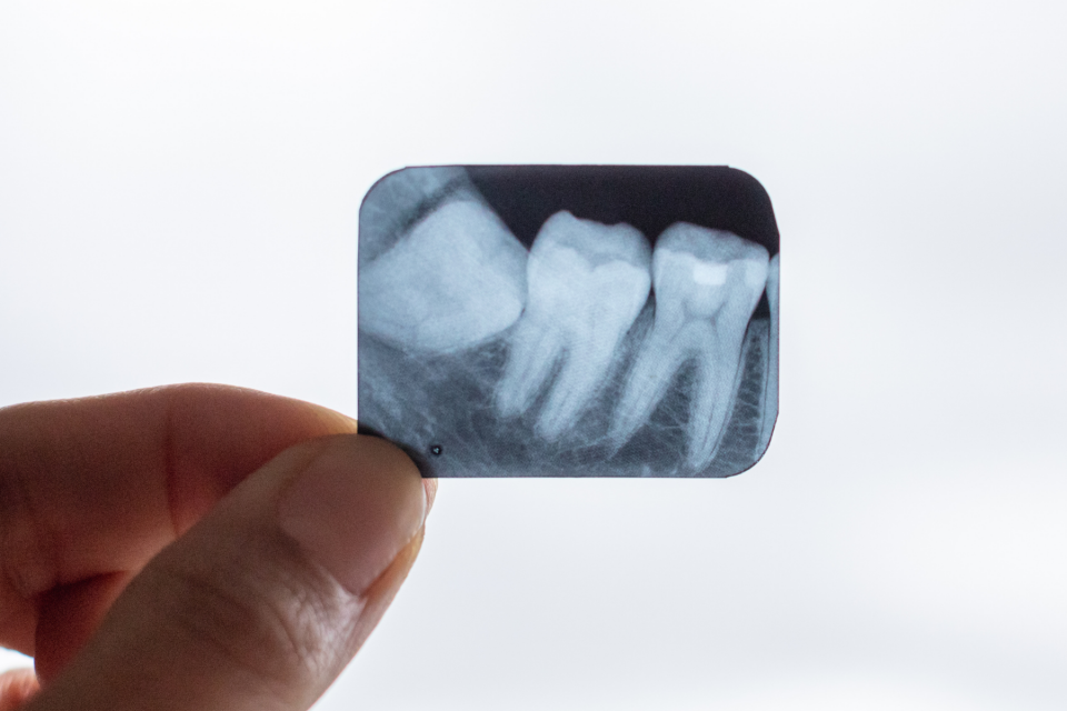 rentgens, kurā redzams nepareizi ieaudzis gudrības zobs
